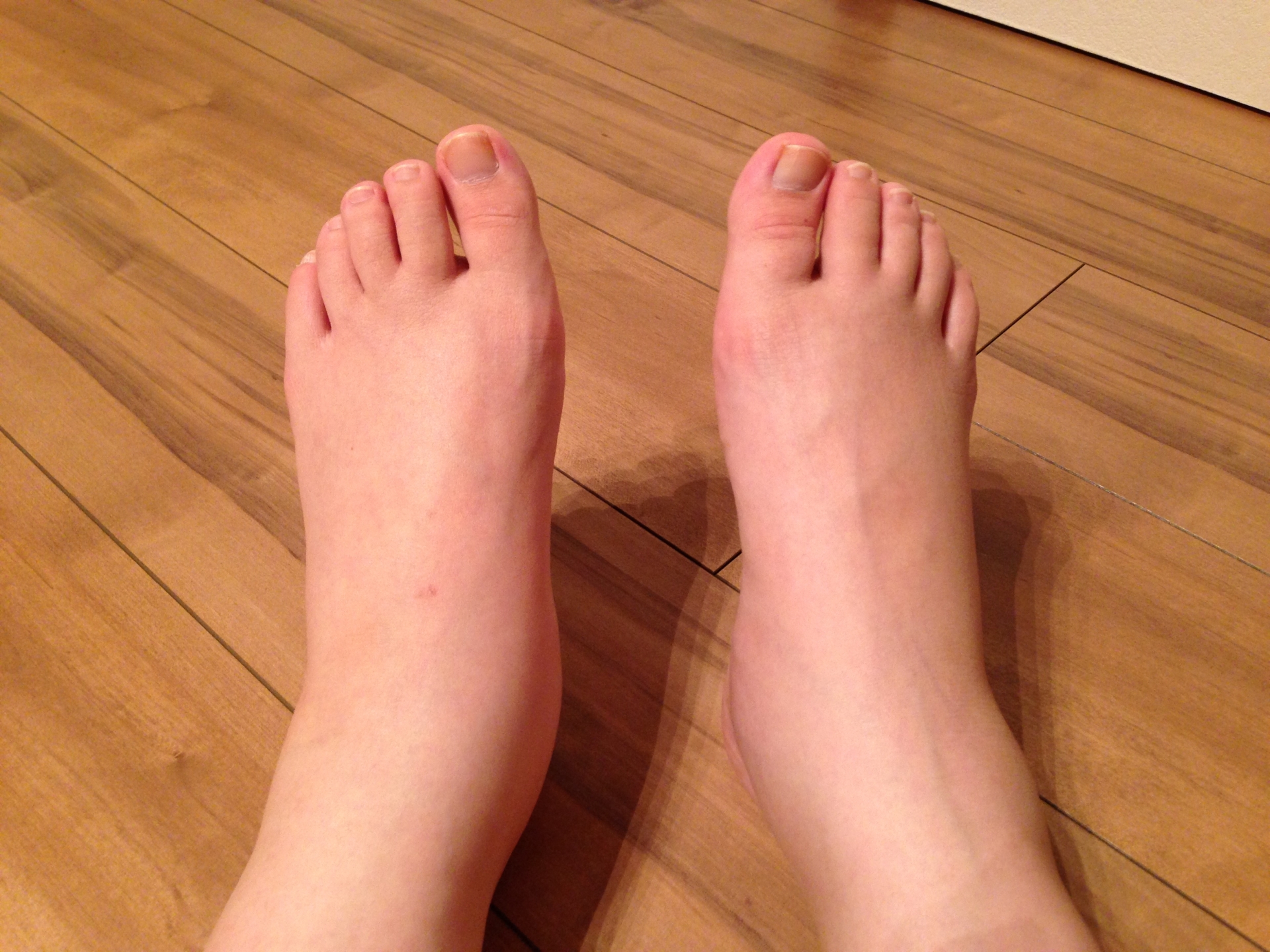 むくんだ足先