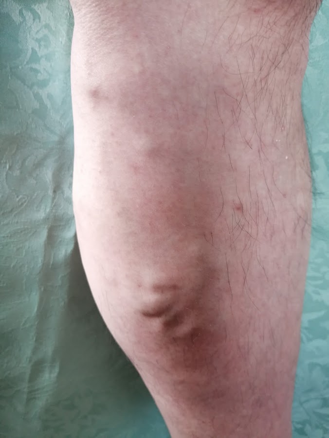 下肢静脈瘤男性脚