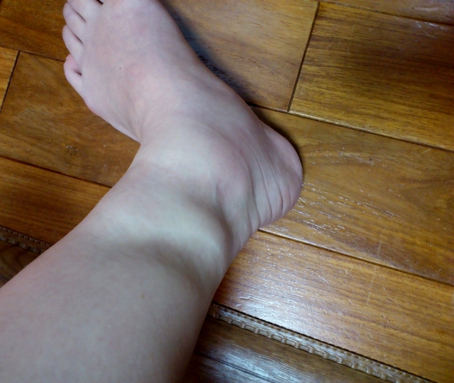 むくみがひどい脚